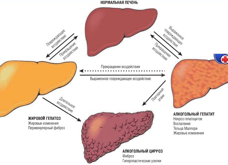 Клиническая картина цирроза печени