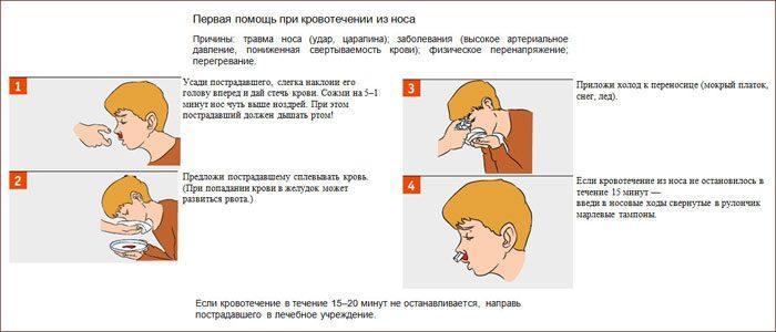 Первая помощь при носовом кровотечении картинки