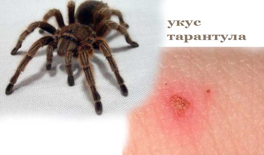 Укусил паук: первая помощь, последствия и возможные осложнения. | parnas42.ru