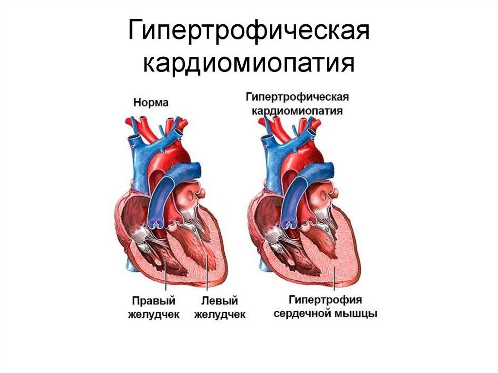 Климактерическая кардиопатия презентация