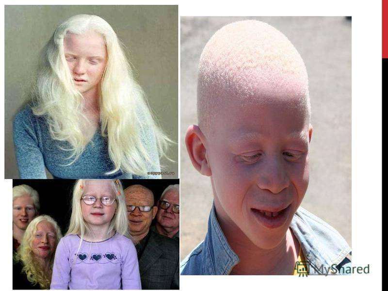 Альбинизмом страдают. Наследственная болезнь альбинизм. Глазокожный альбинизм.