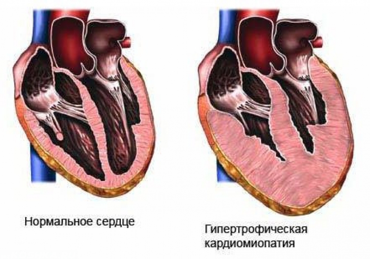 Дилатационная кардиомиопатия