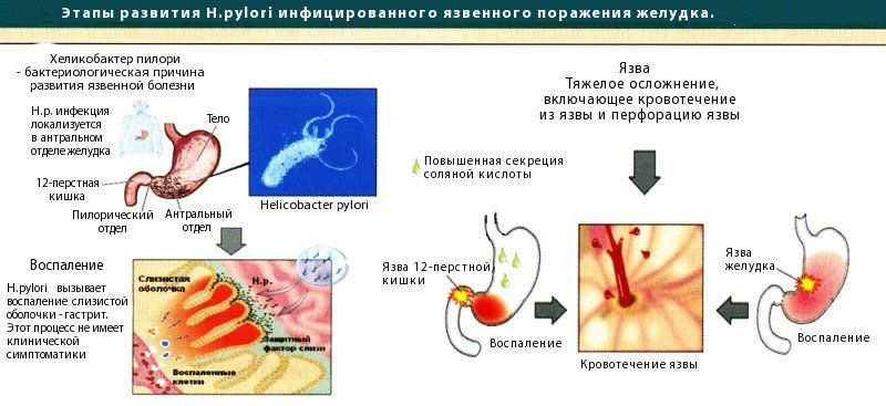 Диета после резекции желудка. рекомендации врачей