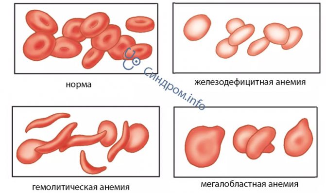 Анемия стул