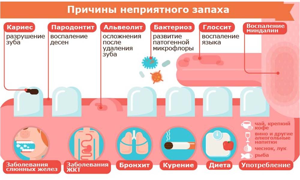 Что делать после лет. Запах изза РТВ причинф. Неприятный запах изо рта.