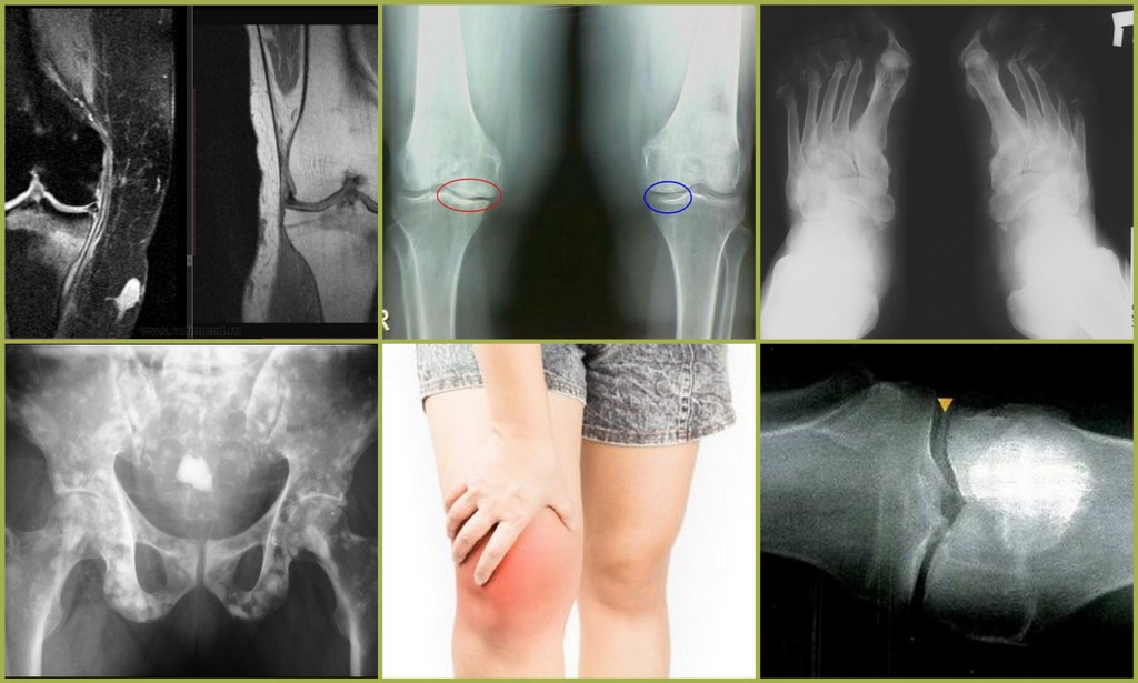 Подагрический артрит сустава - симптомы и лечение