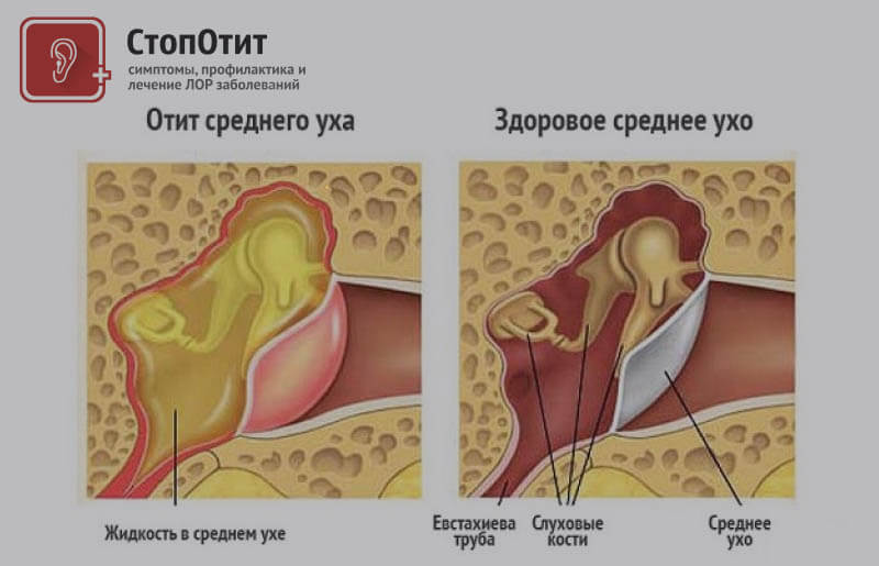 Выделение жидкости из уха. причины, симптомы и лечение